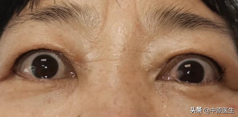 眼睛肿眼球突出怎么办,眼睛胀痛感觉眼球都要突出来一样