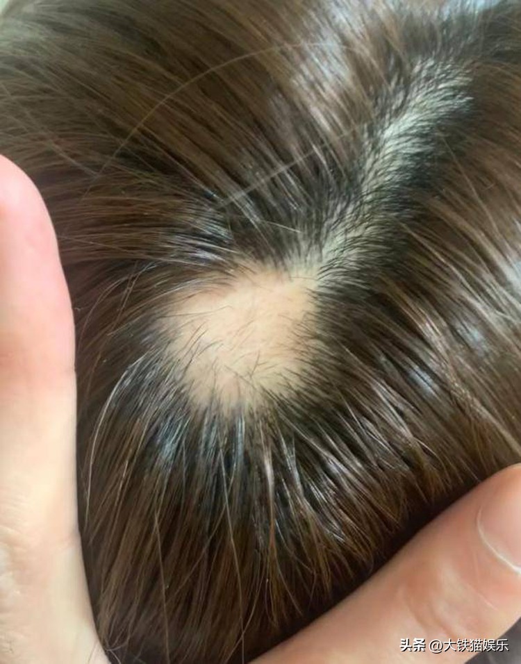 杨幂的头发为什么会秃,杨幂头发变秃了吗
