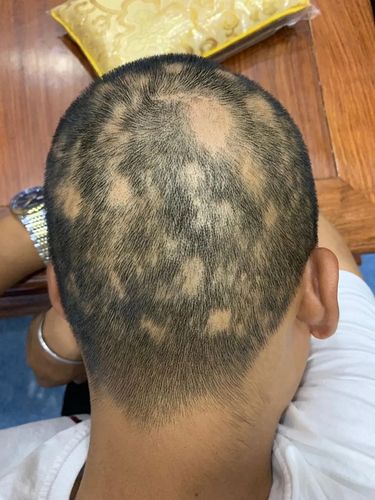 老是鬼剃头是怎么回事,鬼剃头是怎么回事