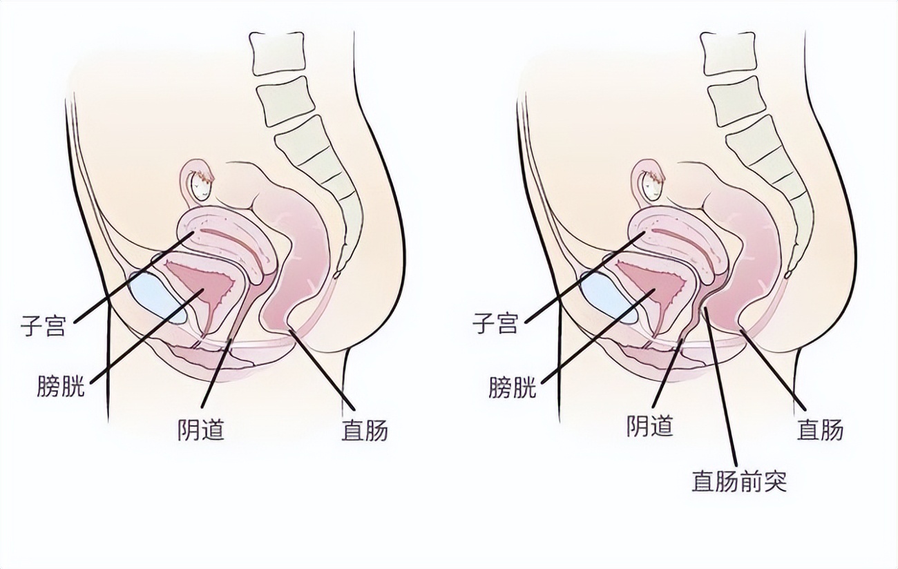 为什么男生天天有拉不完的屎，而女生却很容易便秘呢？