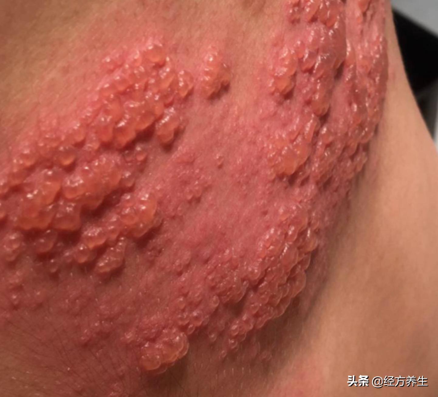 手指湿疹合并汗疱疹,湿疹和疱疹同时有怎么治疗