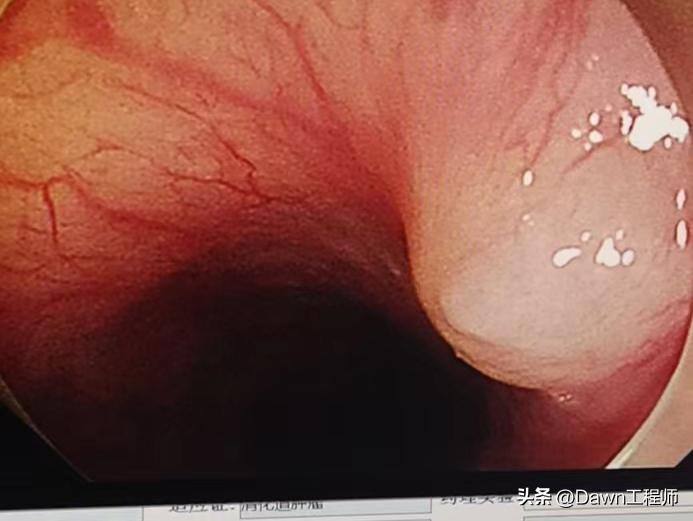 丰县人民医院胃切除手术,食管下段切除肿物手术