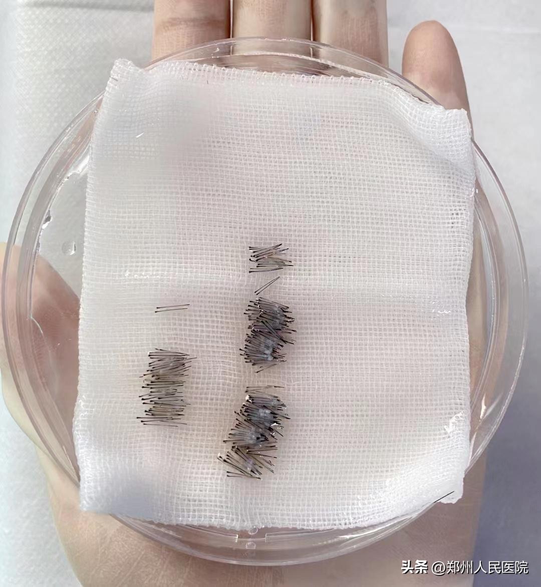 种植眉毛有哪些方法图,怎么种植眉毛效果最好