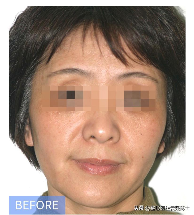 35岁做拉皮能挺几年,三十多岁做拉皮能维持多久