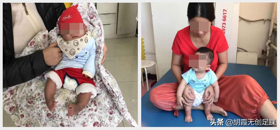 新生儿足内翻保守治疗方法