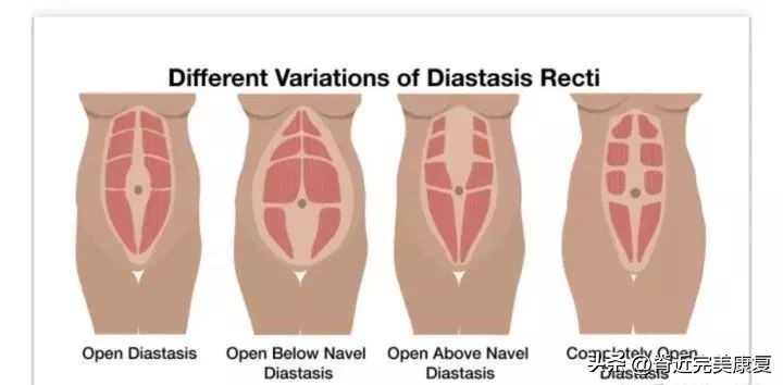 生完孩子后腹直肌一定会分离吗,生完孩子后腹直肌分离是怎么回事