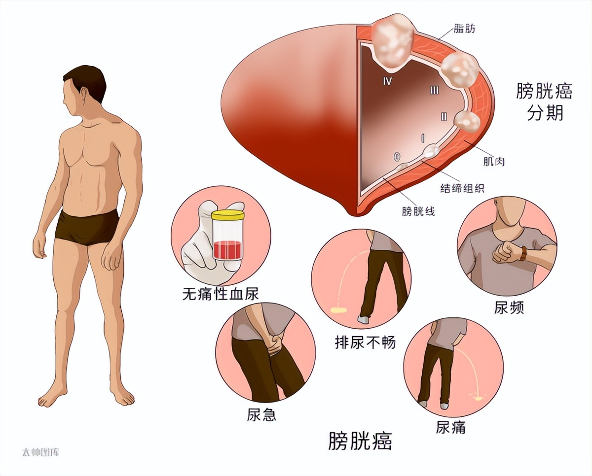 19种癌的早期信号和筛查建议——早知道能救命！