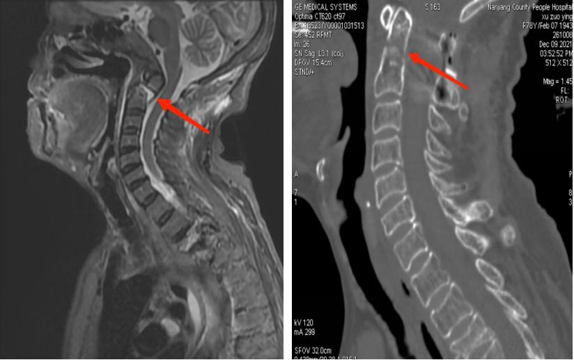 四川南江成功救治一齿状突骨折并寰枢椎脱位患者