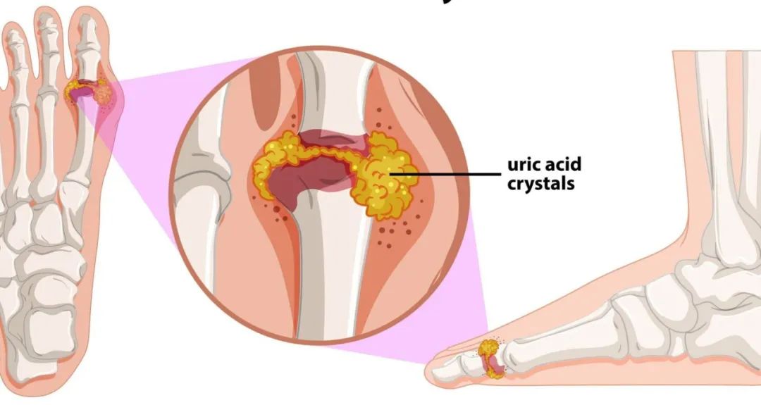 酵母菌过度生长,酵母菌感染是什么原因