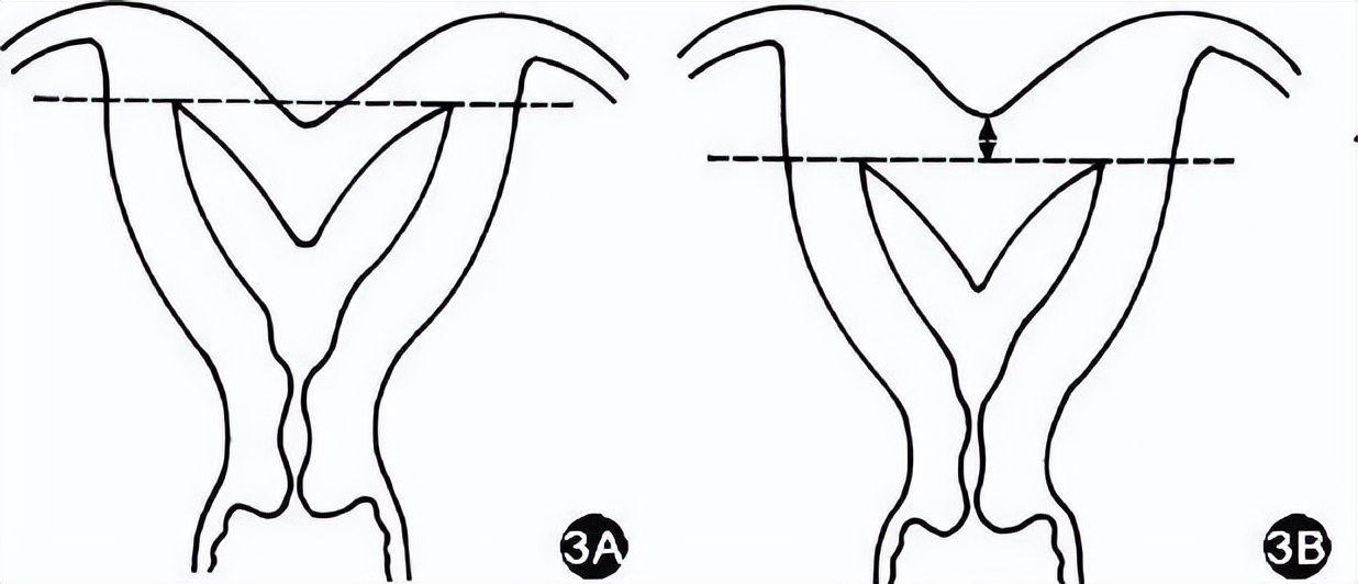子宫畸形造成的胎停好治疗吗,子宫畸形是不是没法生孩子了