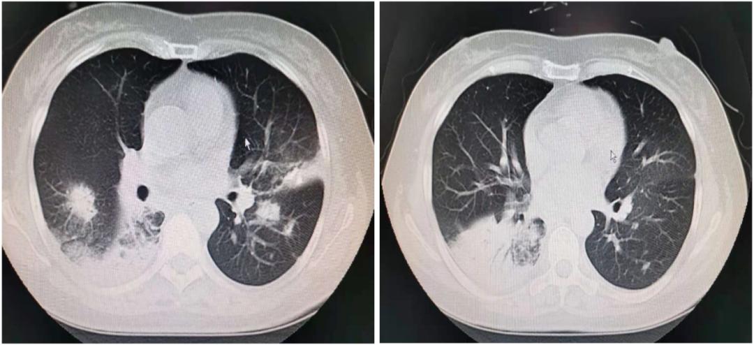 劳累引起发烧反复,劳累后发热属于气虚发热么