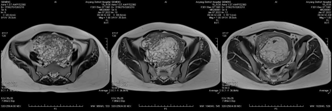 这么典型的葡萄胎MRI影像，快来学习吧