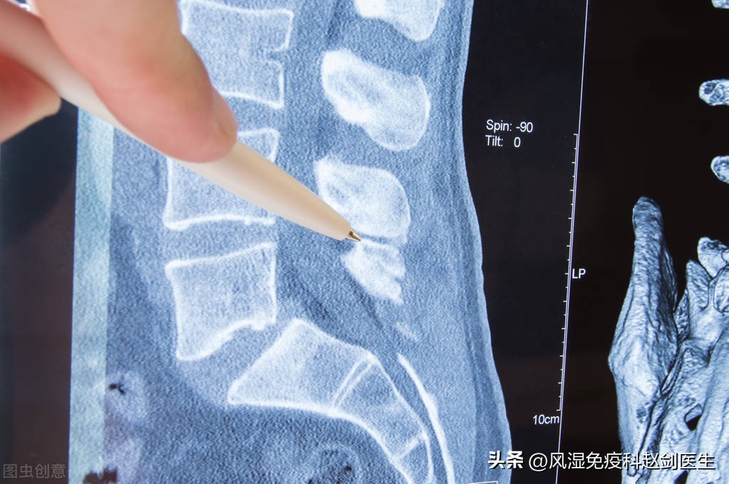 腰突马尾神经综合征发病率,坐骨神经跟马尾神经是一回事么