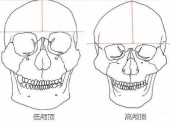 颅顶高发际线低怎么办,颅顶低降低发际线