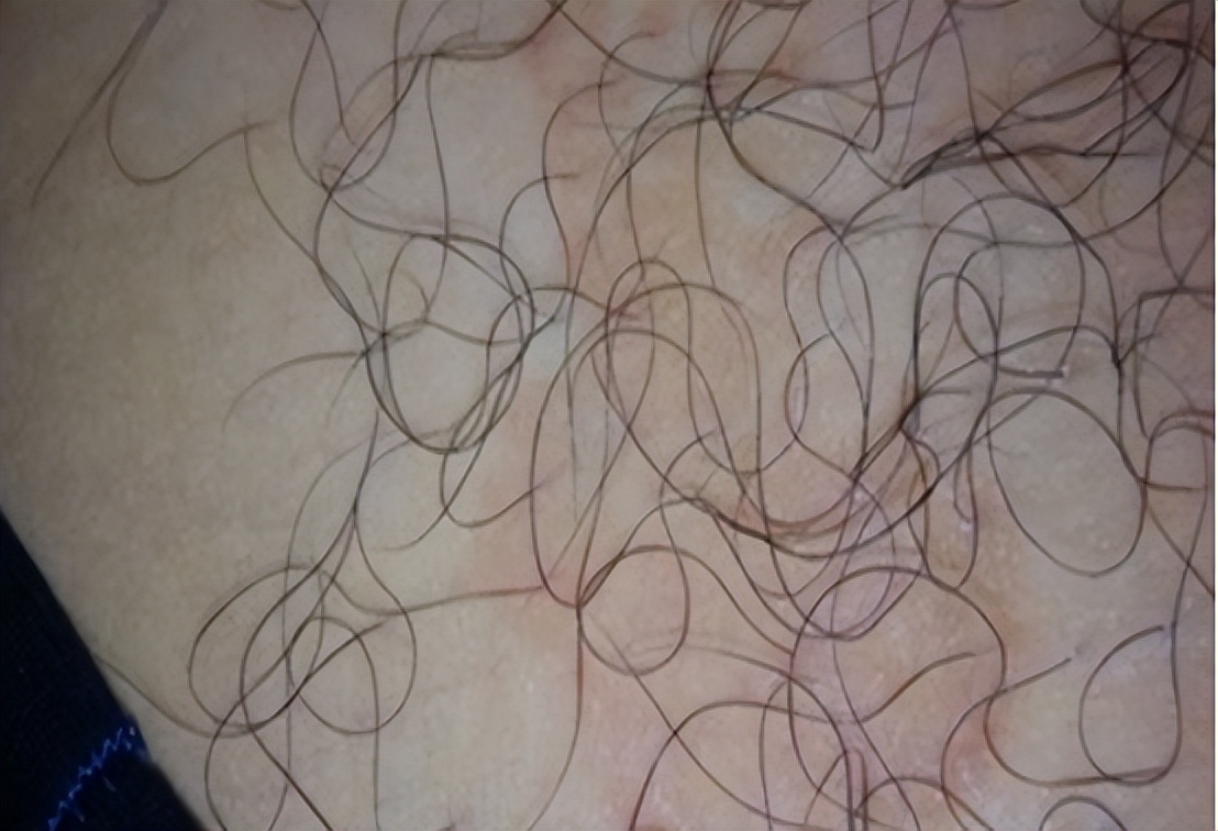 阴虱到底是什么原因引起的,什么是阴虱阴虱是怎么得的