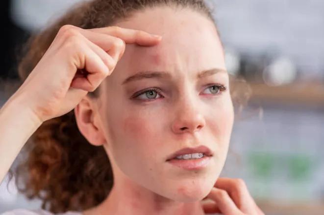 淡化痘印淡斑美白小妙招,美白淡斑淡化痘印推荐