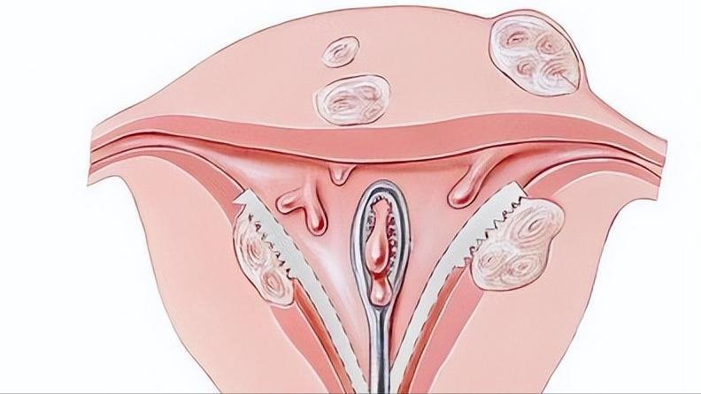 女的最近老是腰疼是宫颈癌吗,女生腿疼警惕癌症