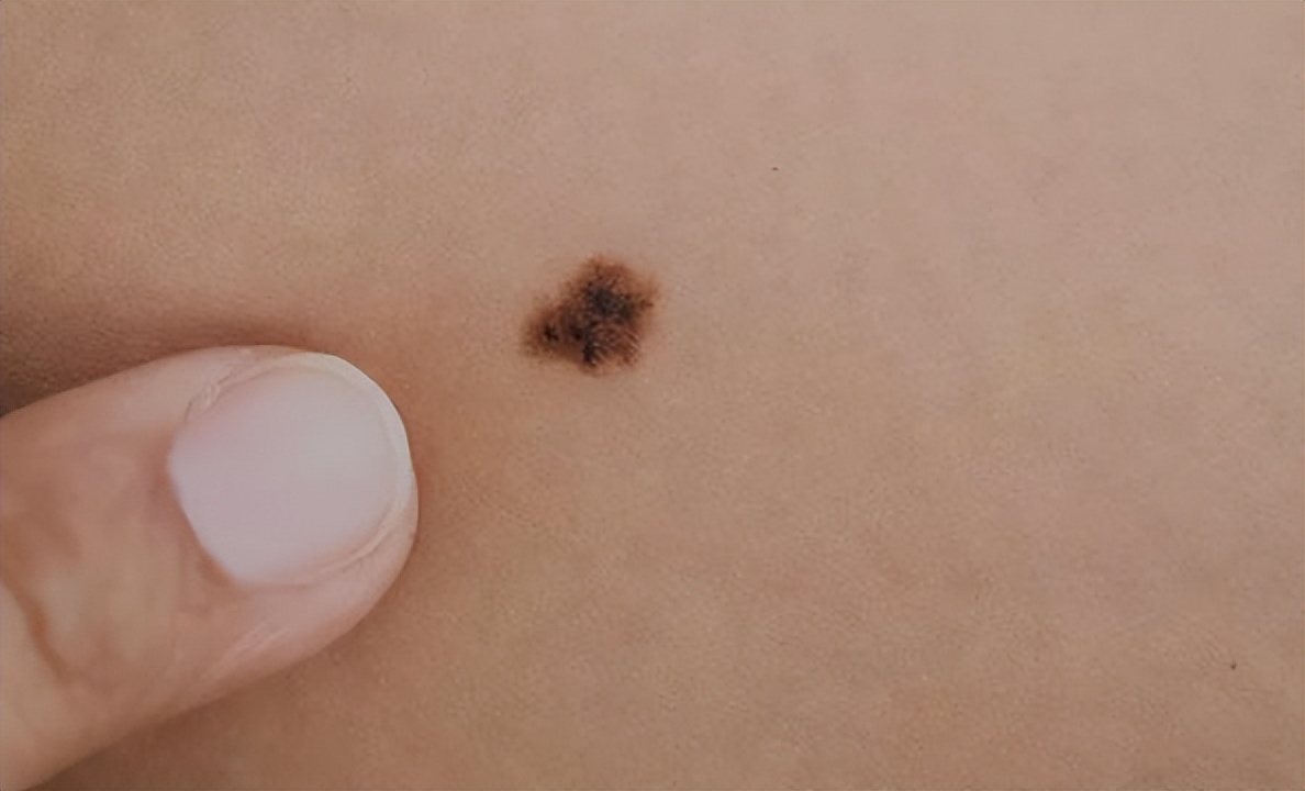 黑痣长在脸上各部位代表什么图片,医生说黑痣有癌变的可能怎么办