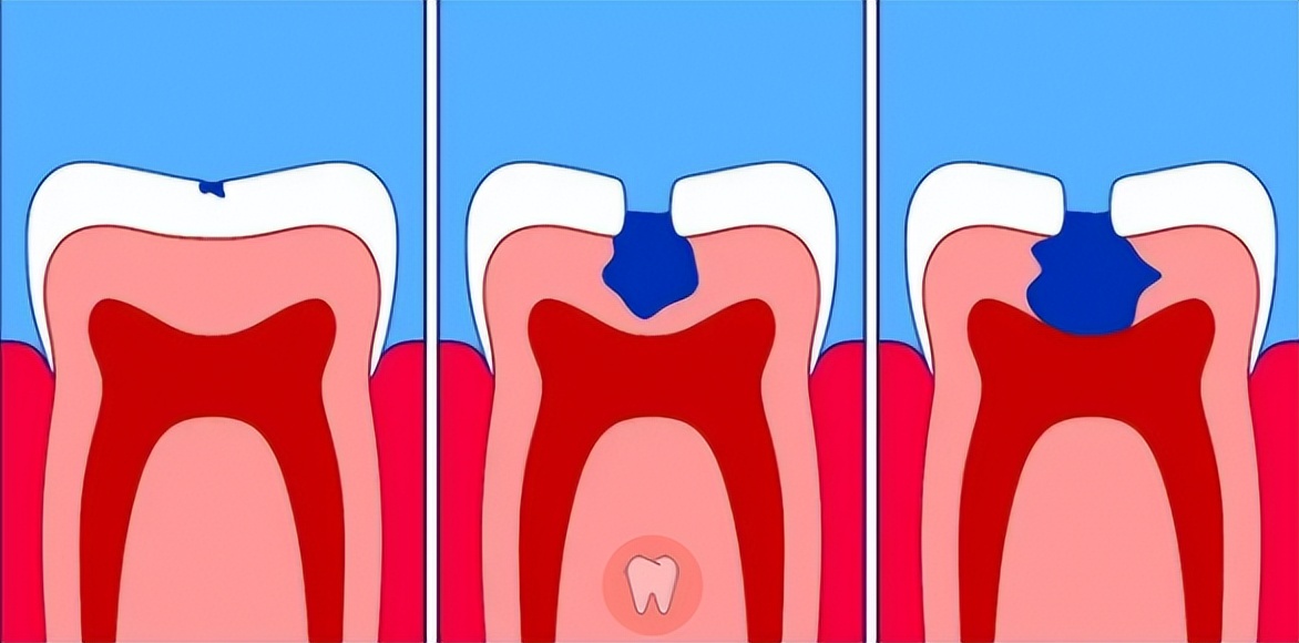 牙科恐惧症如何缓解,牙科焦虑症和牙科畏惧症