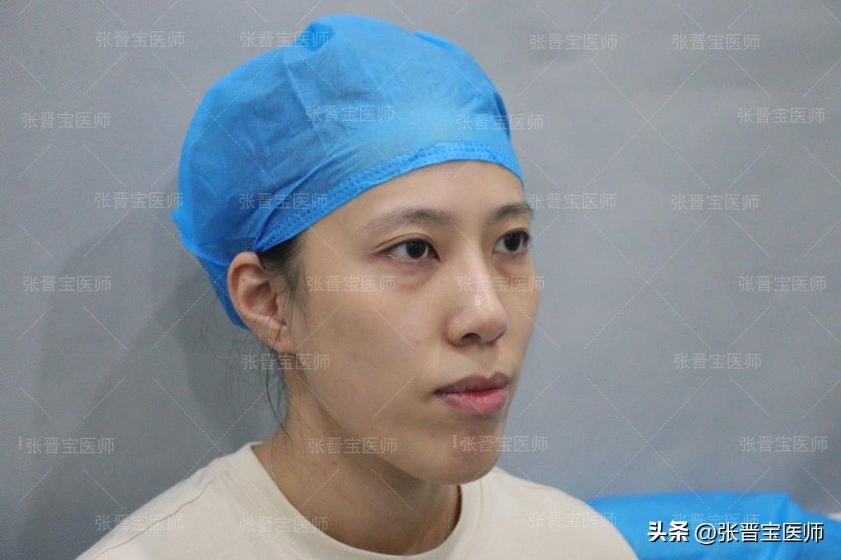 44岁女做眼袋切除适合吗,眼袋手术28岁