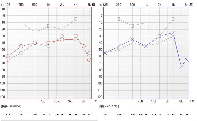 耳膜穿孔手术门诊可以做吗,潍坊鼓膜穿孔手术