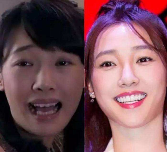 明星做烤瓷牙变凸嘴,明星烤瓷牙凸嘴