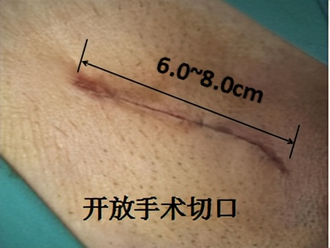 膈疝和疝气是不是一种病,疝气在小肚子上是什么疝