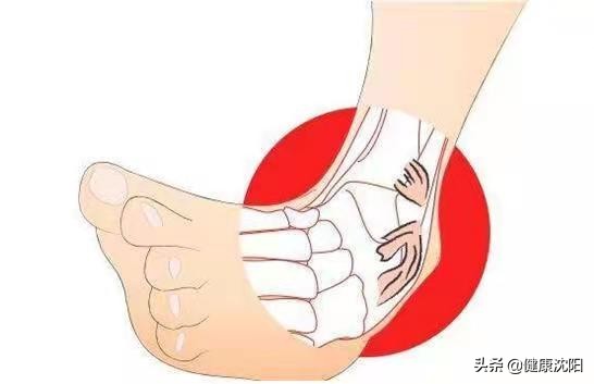 滑雪脚崴了多久能好,滑雪崴脚脚肿多长时间能好