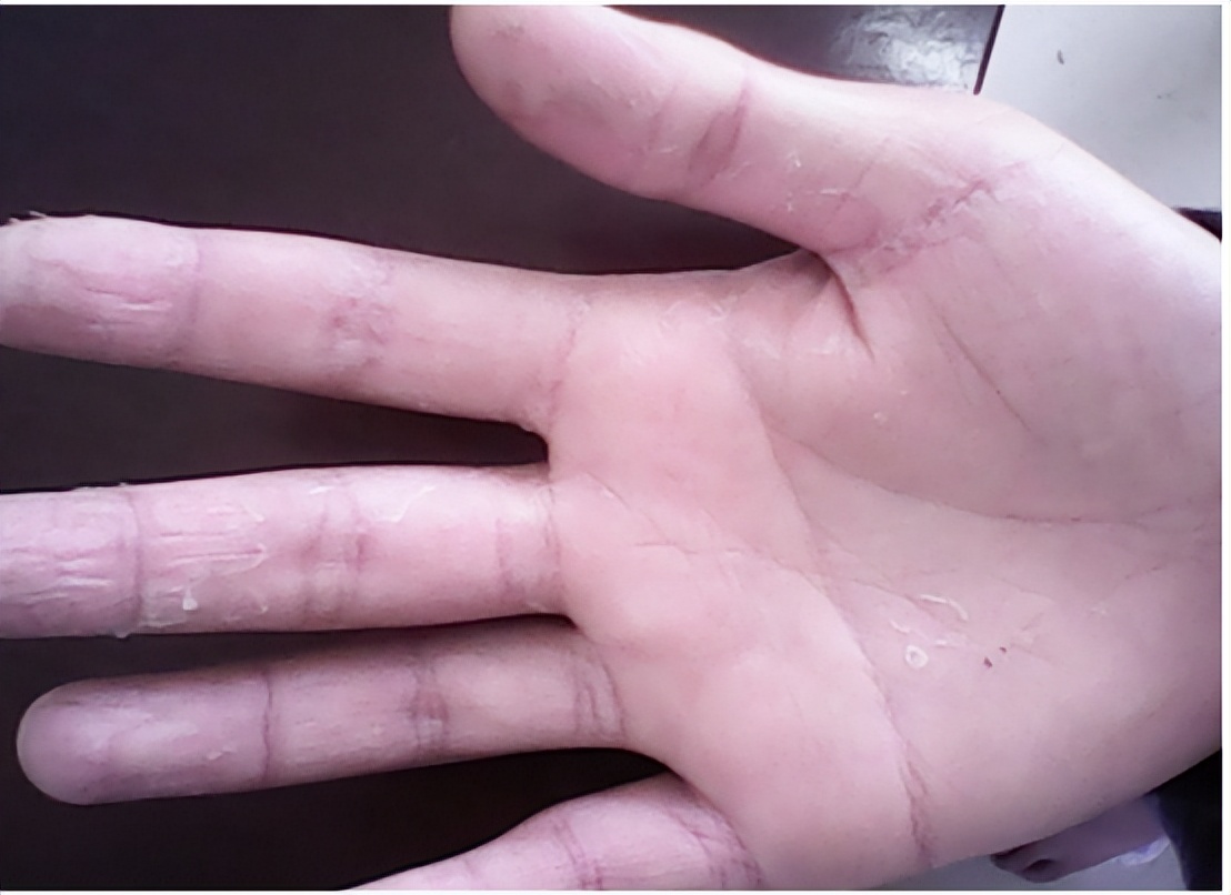 手脱皮开裂痒长癣专用乳膏,手脱皮手癣怎么回事