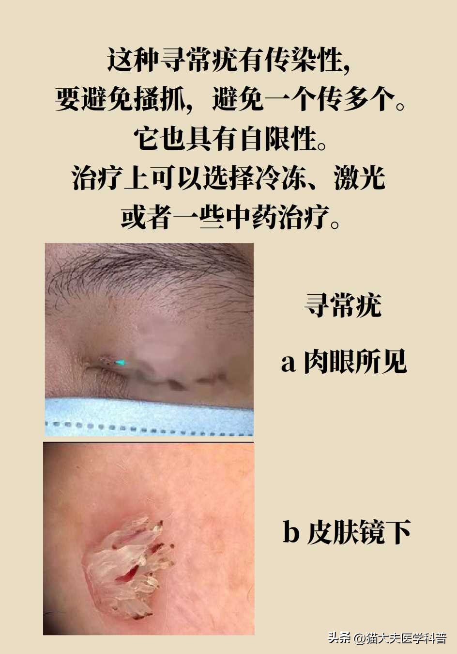 脖子上长的小肉揪怎么治啊,疣丝是不是脖子上的小肉粒