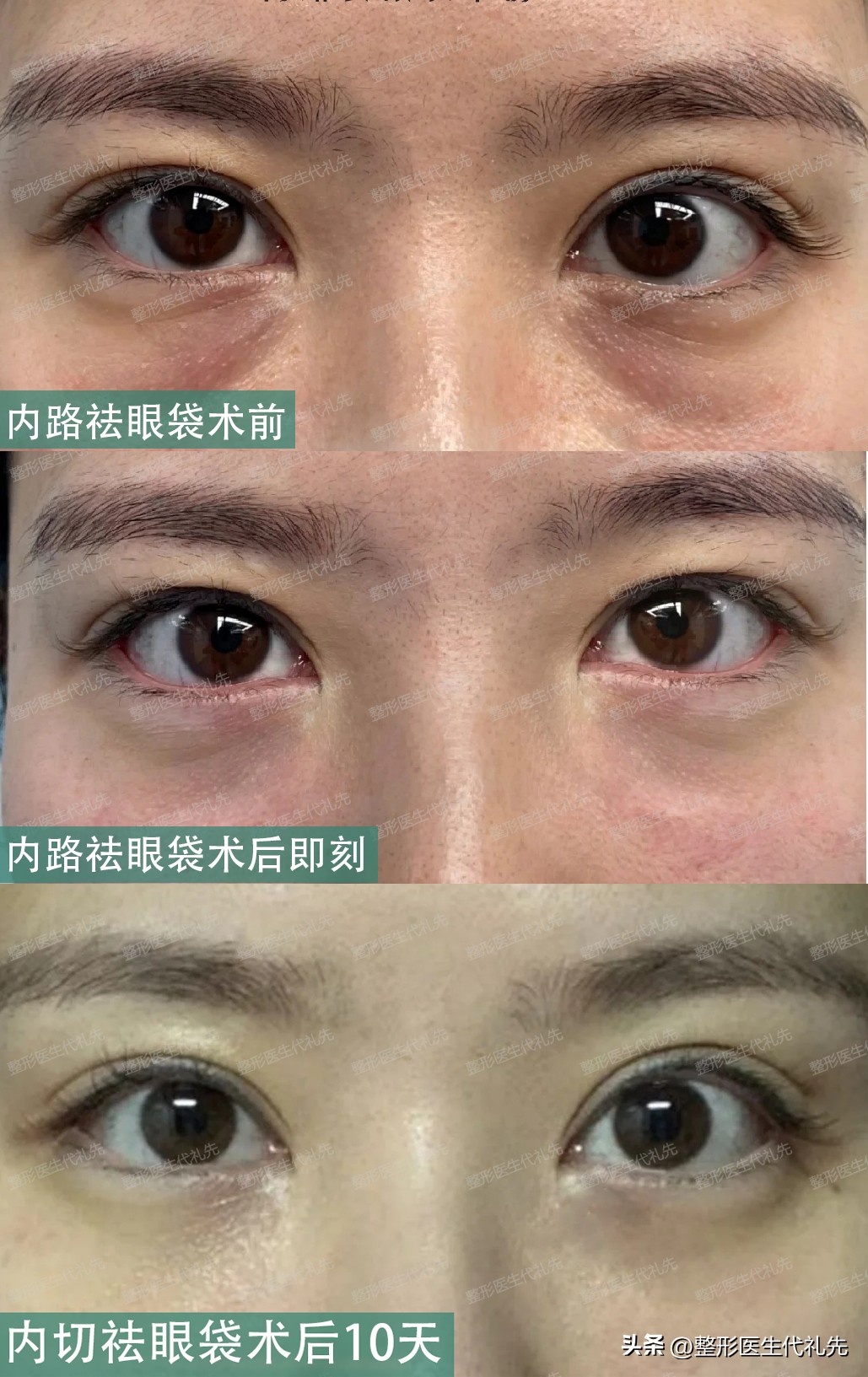 内切祛眼袋手术亲身经历恢复,作为一名整形医生对整形的理解