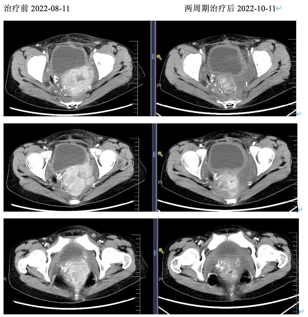 外阴鳞癌放疗后复发还能活多久,宫颈鳞癌化疗后病灶没缩小