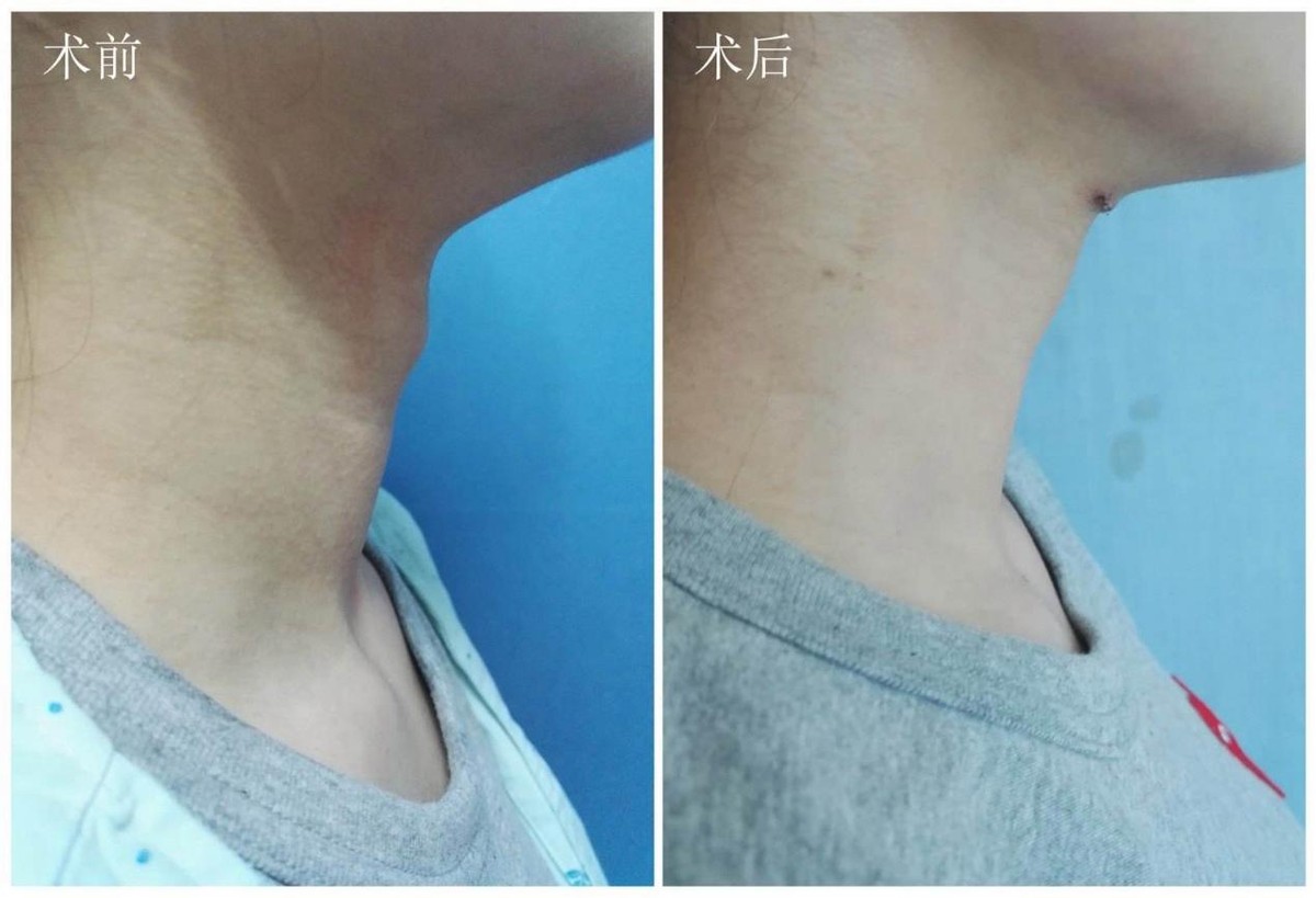 “她”切除了阴茎和*丸睾**，却成了“太监”，变性和阉是一回事儿？