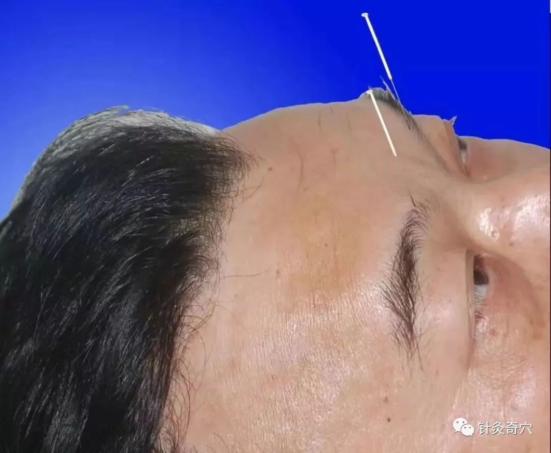 史上最全中医针灸视频教程全集,针灸治疗真实图片大全