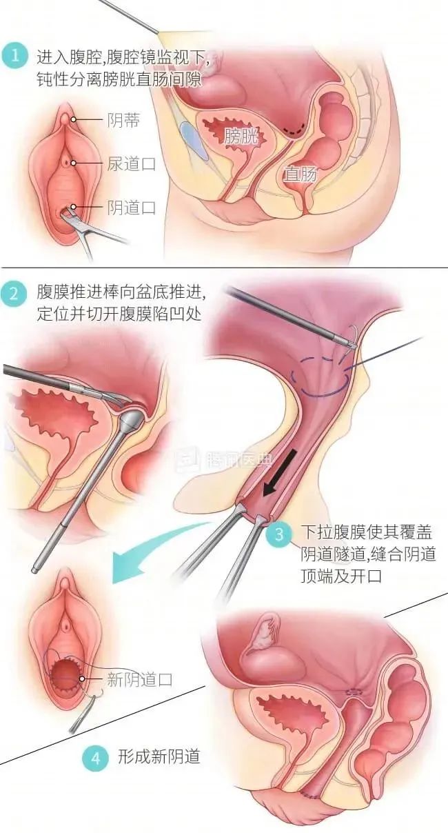成都一家医院成功实施首例“石女”阴道再造术