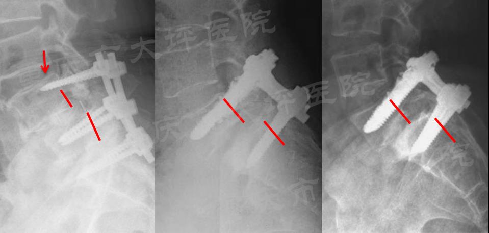 骨水泥螺钉治疗腰椎骨折,骨水泥钉技术
