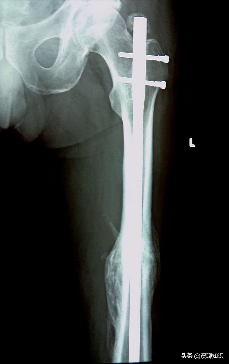 慢性复发性骨髓炎儿童案例,青少年得慢性骨髓炎能治好吗