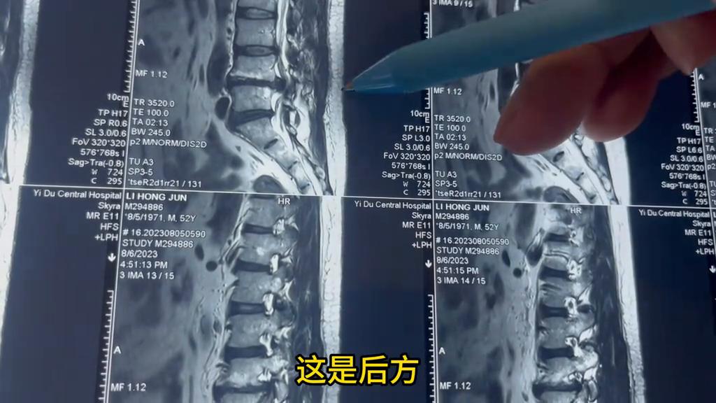 腰疼腿麻是怎么回事六十多岁,左边腰痛连带腿痛腿麻是怎么回事