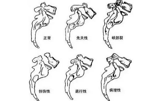 你的腰骨折过吗,你的腰椎