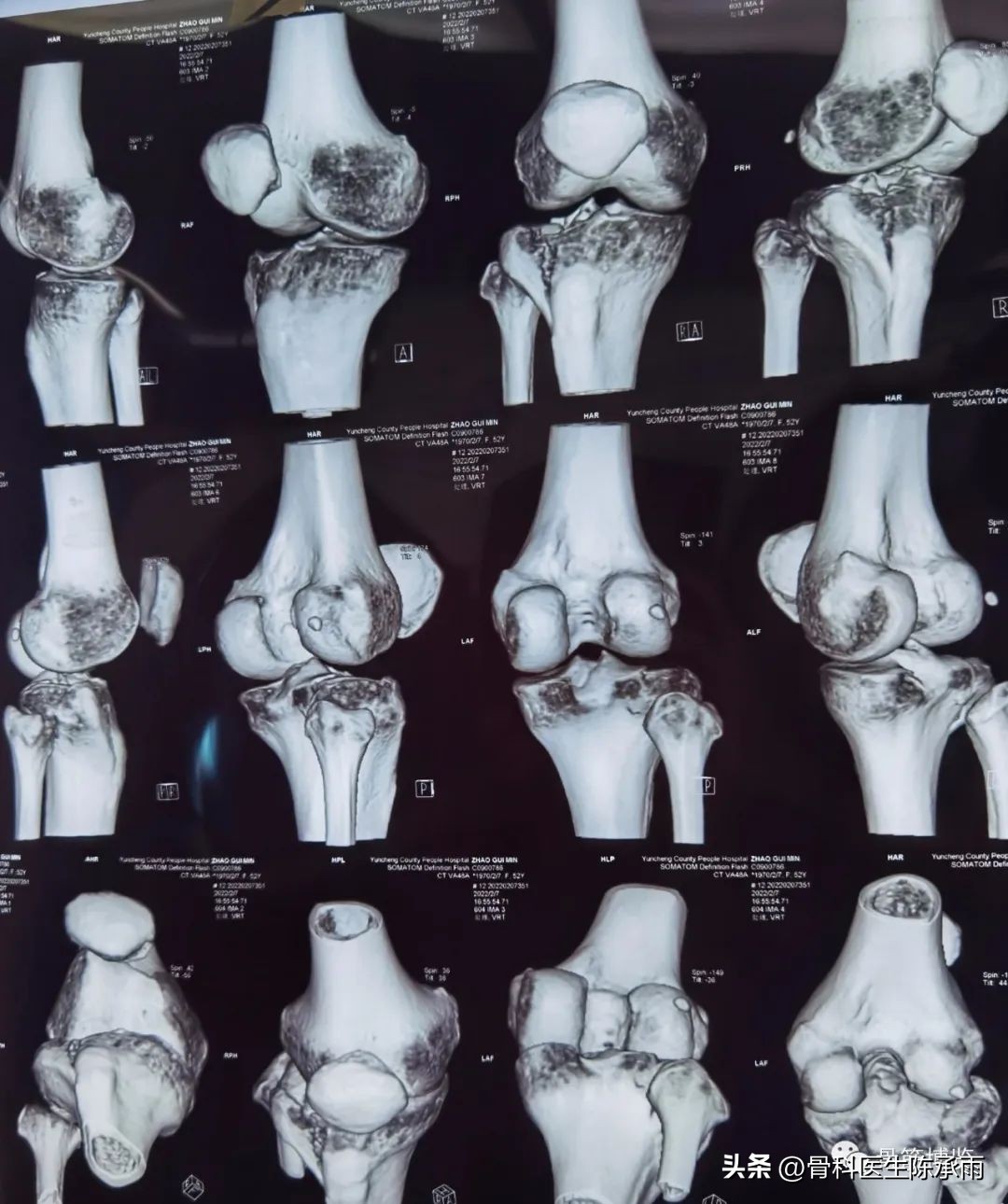 膝关节胫骨平台骨折,最近胫骨平台骨折视频