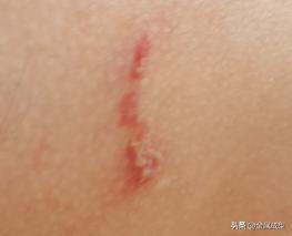 紧迫的！陕西被发现了！男子皮肤多处溃烂，5天仍未愈合