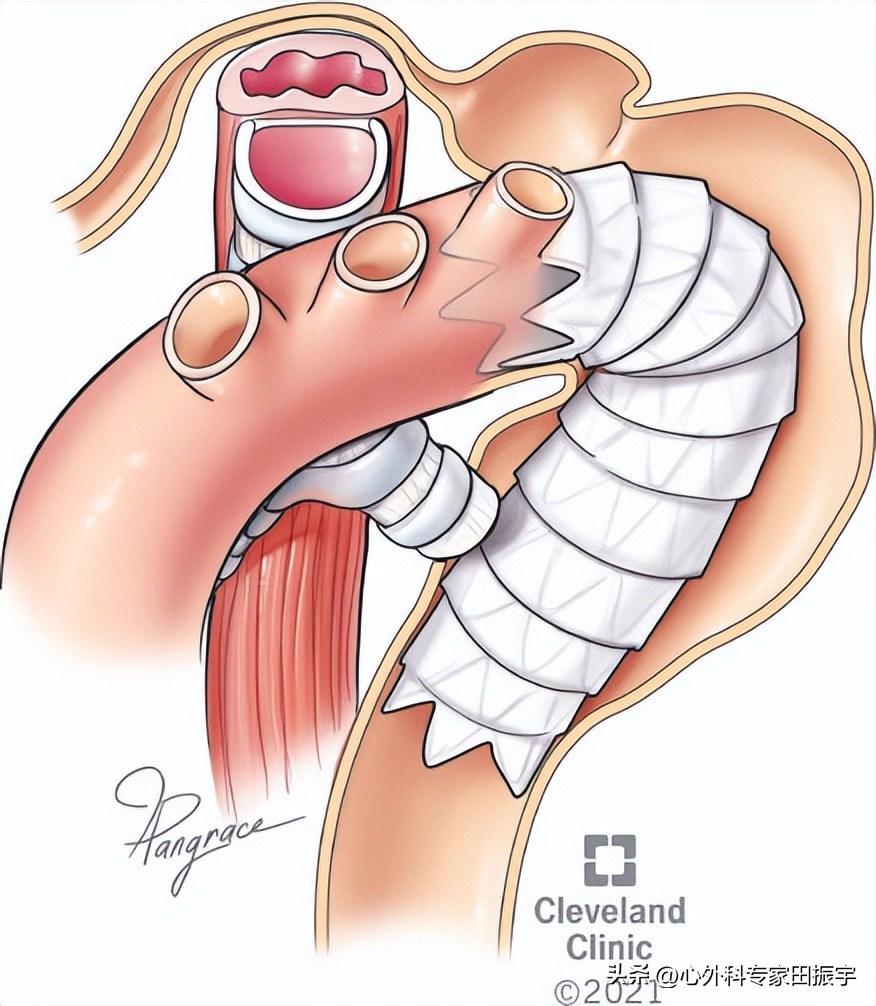 Kommerell憩室和迷走型锁骨下动脉修复术