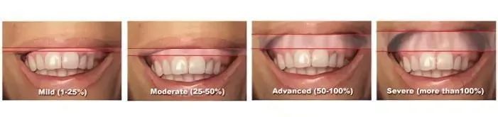 孩子露龈笑越来越明显是怎么回事,露龈笑打肉毒素多久才完全恢复