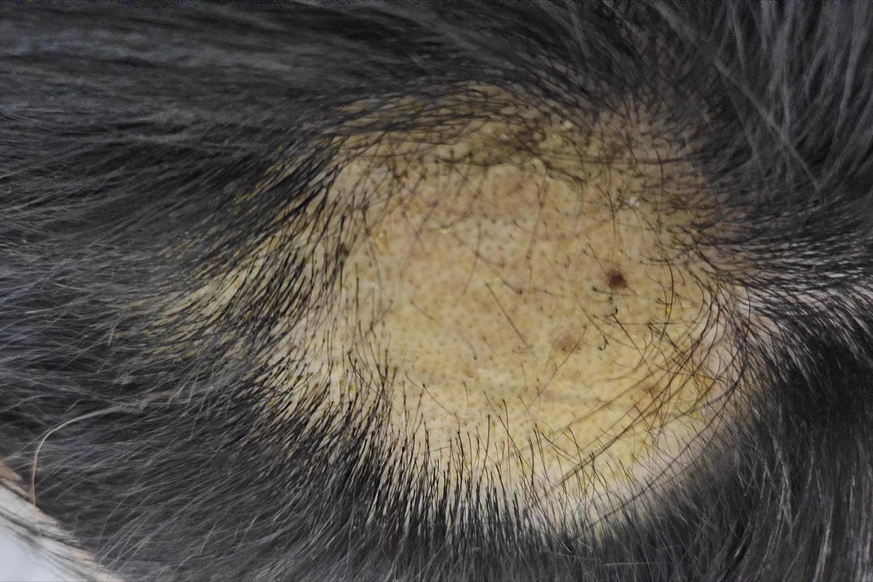 脱发人群请远离激素米诺地尔,斑秃脱发自愈的经历