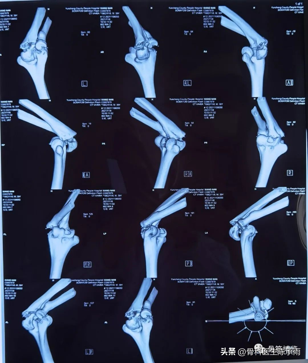 肘关节恐怖三联征最新治疗方法,肘关节恐怖三联征最佳治疗方法