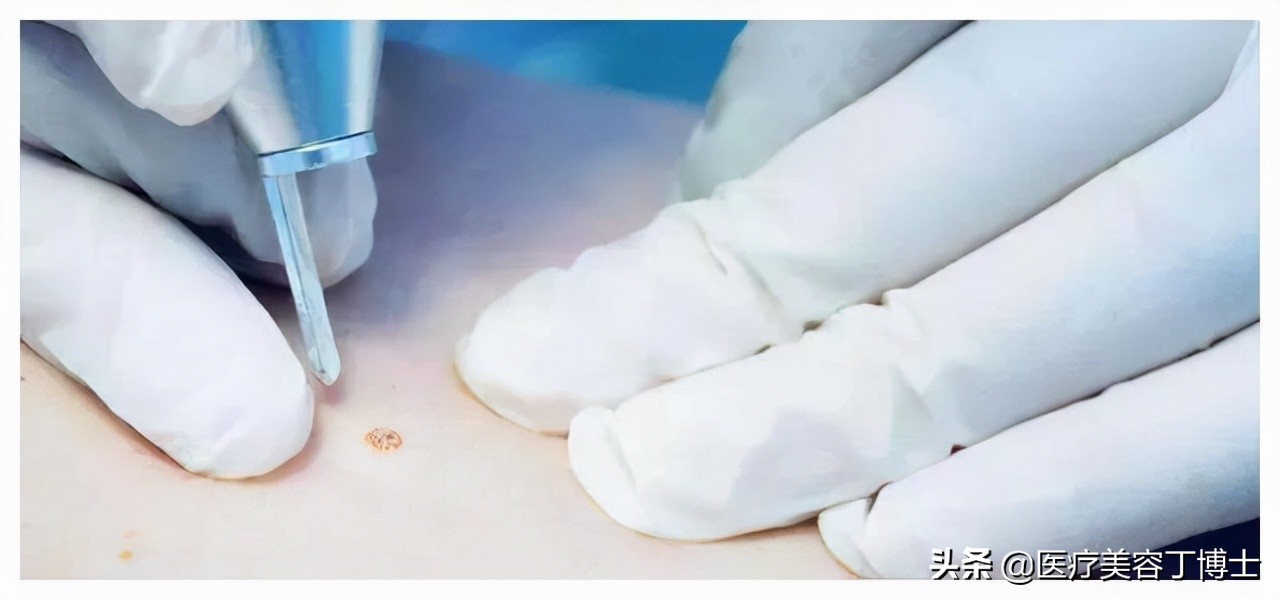 太田痣是怎么形成,太田痣是怎么形成的