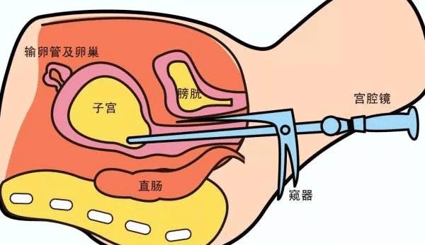 这种方式的腹腔镜手术，真正实现腹部“零瘢痕”