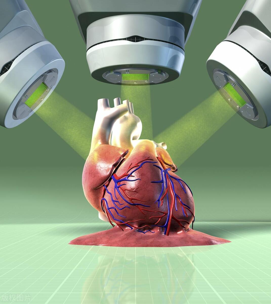 冠心病放支架好还是药物治好,冠心病是放支架还是保守治疗