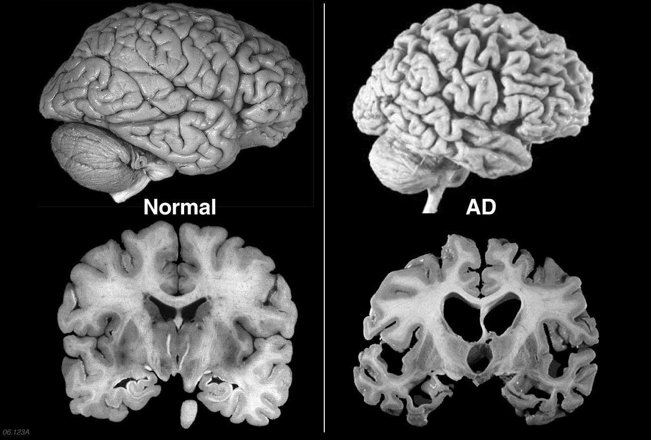 致死率100%！朊病毒无药可救且烹煮杀不死，感染后会有多恐怖？