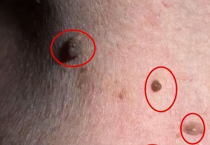 脖子和腋下的“小肉粒”是什么？能直接用手揪掉吗？医生揭露真相